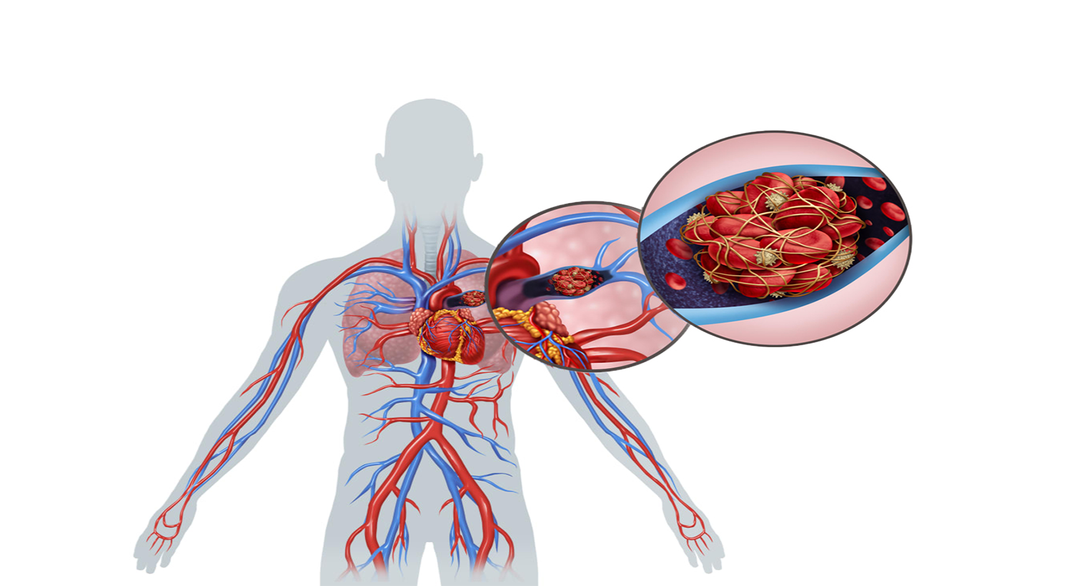 Pulmonary Embolism Treatment in Hyderabad